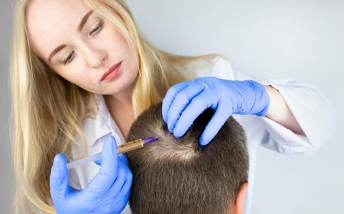 alopecia